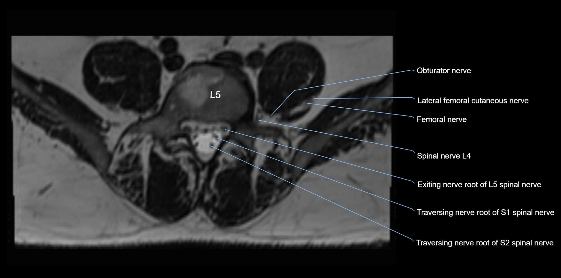 MR lumbosacral plexus axial cross sectional anatomy 3T  radiology  image-img-1008001-00052.webp